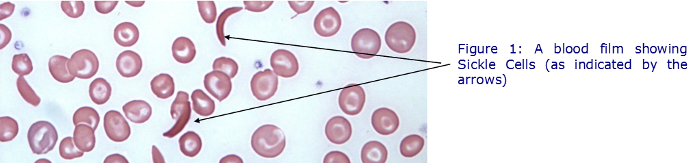 sickle cell 1.png