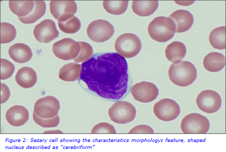 sezary cells